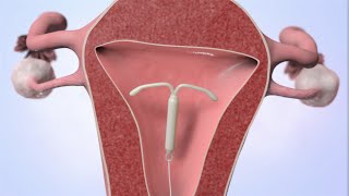 Patient Education Video Intrauterine Device IUD [upl. by Rebecca]