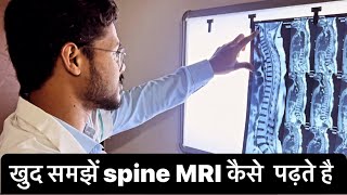 ख़ुद समझें Spine MRI कैसे पढ़ते है mri spine slip disc ￼ [upl. by Niran]