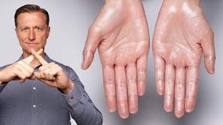 How to Stop Excessive Sweating Hyperhidrosis [upl. by Flory230]