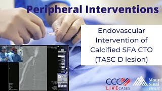 Endovascular Intervention of Calcified SFA CTO TASC D lesion  December 18 2013 Live Case Video [upl. by Bibbye]