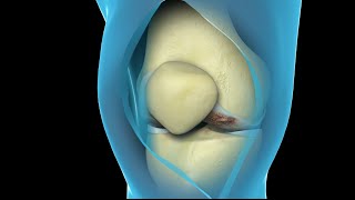 Total Knee Replacement Surgery  Nucleus Health [upl. by Wonacott]