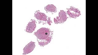 Multiple Schwann cell hamartomas [upl. by Yhtrod]