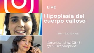 Hipoplasia del cuerpo calloso [upl. by Atihana]