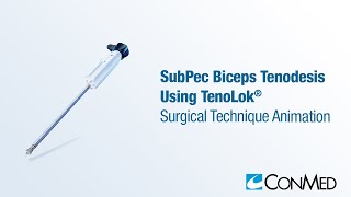 SubPec Biceps Tenodesis Using TenoLok®  CONMED Animation [upl. by Klepac]