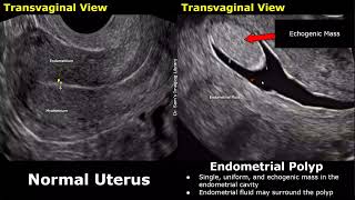 Uterus Ultrasound Normal Vs Endometrial Polyp Images  Feeding Artery Interrupted Mucosa Sign USG [upl. by Devine7]