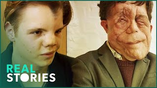 The Ugly Face of Disability Hate Crime Adam Pearson Documentary  Real Stories [upl. by Gawain35]