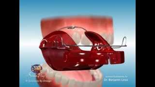 ScreenPlay Orthodontic Education Videos Bionator Appliance [upl. by Latham]