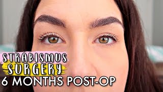 ESOTROPIA STRABISMUS SURGERY UPDATE 6 MONTHS POSTOP 2020  STRABISMUS SURGERY Before And After [upl. by Zoldi]