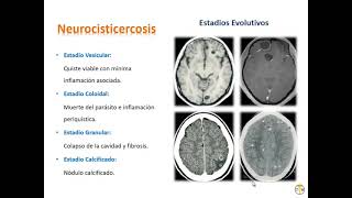 Infectología  2 Cisticercosis [upl. by Ottilie]