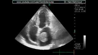 Mitral Stenosis with Left Atrial Thrombus [upl. by Nesbitt]