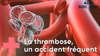 Thrombose  toutes vos questions  Allo Docteurs [upl. by Seroled]