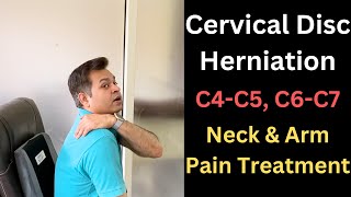 Cervical Disc Herniation C5C6 Neck and Arm Pain Cervical Symptoms Cervical Radiculopathy [upl. by Elirpa]