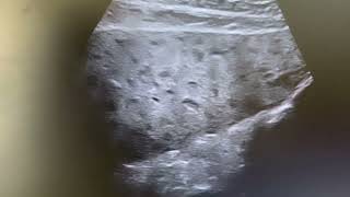 Ultrasound of multiple hypoechoic thickened intrahepatic biliary radicles due to biliary obstruction [upl. by Becka]