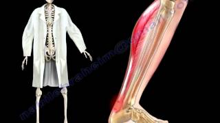 Achilles Tendon Stress amp Strain  Everything You Need To Know  Dr Nabil Ebraheim [upl. by Pacifica473]