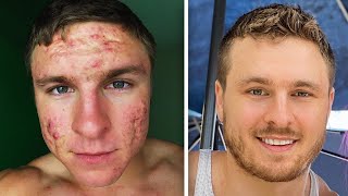 How I Got Rid of My Acne For Good YOU CAN TOO [upl. by Anaiek]