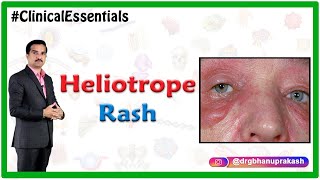 Heliotrope rash in Dermatomyositis  Clinical Essentials [upl. by Ahsiekrats]