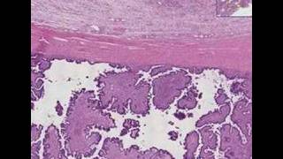 Histopathology OvaryBorderline ovarian tumor [upl. by Lefton]