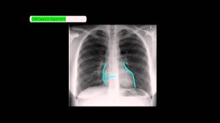 Chest XRay Reading Method  ABCDE UndergroundMed [upl. by Chalmer]