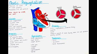 Aortic Regurgitation  Causes Symptoms Diagnosis Treatment Grading [upl. by Solracnauj]