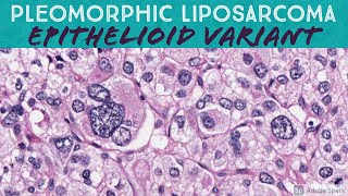 Pleomorphic Liposarcoma Epithelioid Variant [upl. by Gautea]