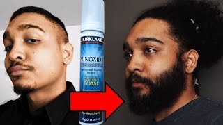 14 Men Who Grew A Beard With Minoxidil [upl. by Atteynod]