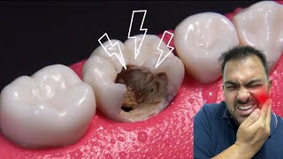 INCRIVEL RECONSTRUÃ‡ÃƒO DE DENTE DESTRUÃDO POR CÃRIE ENDODONTIA CANAL EM 4K [upl. by Linder627]