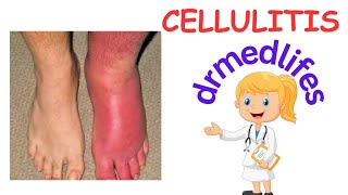 cellulitis  causes clinical features  investigation treatment [upl. by Llerrut990]