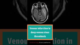 Venous infarction in deep venous sinus thrombosis  Radiology tutorials  video 56 [upl. by Scheers]