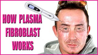 Plasma Fibroblast  How Fibroblast Plasma Works Beneath the Skin [upl. by Noble761]