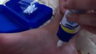 Dr Scholls Dual Action Freeze away wart remover how to for large warts [upl. by Timmie]