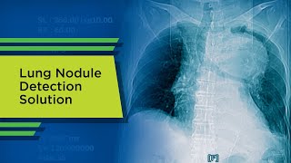 Lung Nodule Detection Solution [upl. by Osnola93]