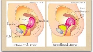 UTERO RETROVERSO [upl. by Oniuqa]
