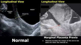 Obstetric Ultrasound Normal Pregnancy Vs Placenta Previa  LowLying Marginal Partial Complete [upl. by Theobald]