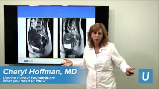 Uterine Fibroid Embolization  Cheryl Hoffman MD  UCLAMDChat [upl. by Lezley]