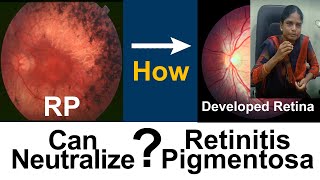 Retinitis Pigmentosa  How she got useful vision  Medical Improvement  DrSasi [upl. by Asina]