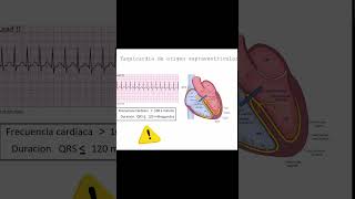 Caracteristicas y Diagnostico de las Taquicardias Supraventriculares de Complejo  Dr Jose Porto [upl. by Aibara252]