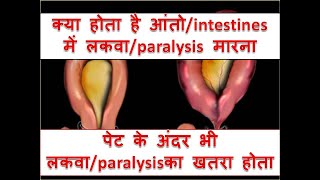 what is INTESTINAL PSEUDO  OBSTRUCTIONPARALYTIC ILEUSOGILVIE SYNDROME [upl. by Zared991]