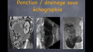 Pancréatite aiguë  3 Diagnostic des complications [upl. by Aralk850]