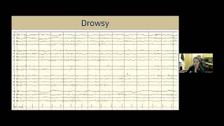 Understanding EEG A Practical Guide for Patients and Families [upl. by Sivla]