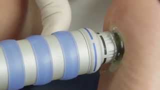 Shockwave Therapy or ESWT Explained [upl. by Bergstrom]