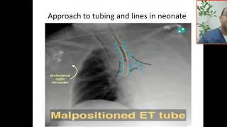 Case 23 malposition of endotaracheal tube what are causes of sudden deterioration on mechanical v [upl. by Sivel]