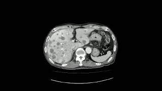 Metastatic liver cancer 전이성 간암 [upl. by Lerim]