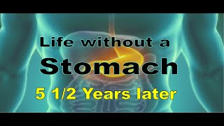 Esophagectomy 5 12 years later [upl. by Yrret]