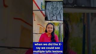 Multiple myeloma case neet mbbs trending viralvideos shorts knowledge multiplemyeloma [upl. by Nelda796]