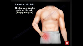 Hip pain causes symptoms  diagnosis and treatment What causes hip pain and how do you treat it [upl. by Nerrual]