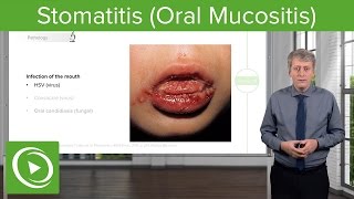 Stomatitis Oral Mucositis – Pediatric Infectious Diseases  Lecturio [upl. by Anyal]