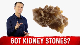 Treatment For Kidney Stone amp Kidney Stone Prevention – Dr Berg [upl. by Kaule600]