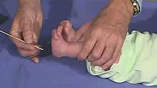 321  Reflexes Plantar Reflex  Newborn Normal  Infant Clinical ExaminationMRCP [upl. by Dirfliw]