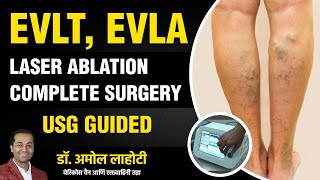 Live Varicose Vein Laser Surgery Full Live Procedure Explained By Dr Amol Lahoti [upl. by Rillis]