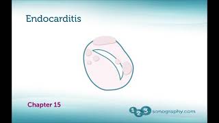 INFECTIVE ENDOCARDITIS ECHOCARDIOGRAPHY  BASICS OF IE Transthoracic vs Transoephophageal Echo [upl. by Gildas]